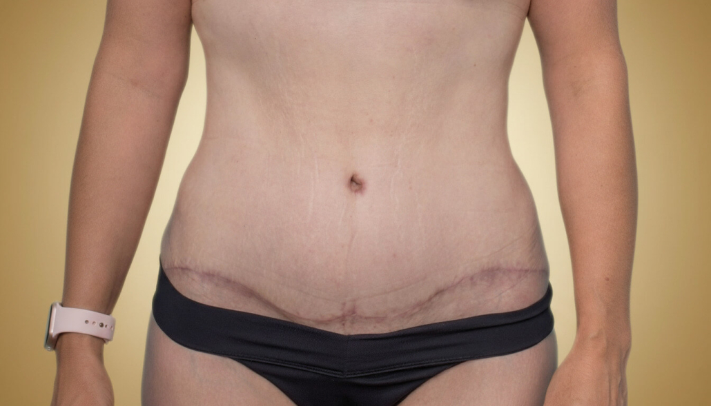 Cicatriz de una abdominoplastia o dermolipectomía abdominal (1 meses)